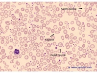 Mikrositik Anemi Nedir?